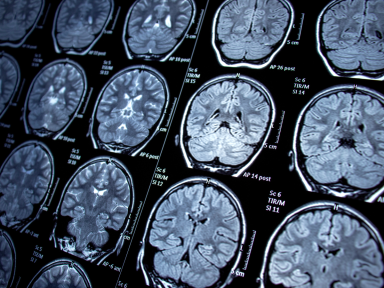 What Is the Difference Between CT Scan and MRI Scan?