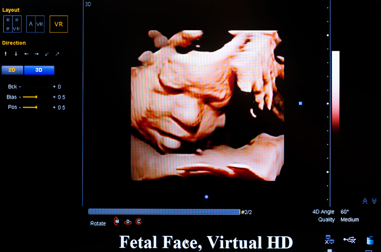 High definition 3d ultrasound Houston fetal face scan showing clear baby features during advanced prenatal imaging session