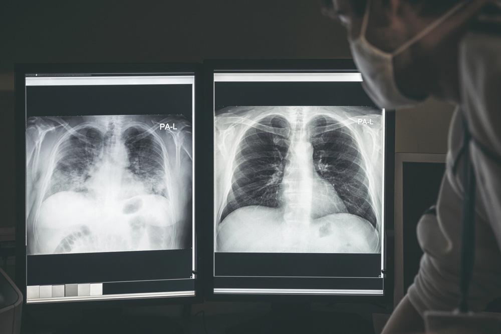 Radiologist in mask reviewing two PA-L chest X-ray images on dual monitors, expert analysis at X-ray services Houston for accurate diagnostics.