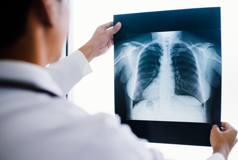 Doctor holding chest X-ray film against light for detailed review, offering quick walk in X Ray Houston services at advanced medical centers for prompt diagnostics.