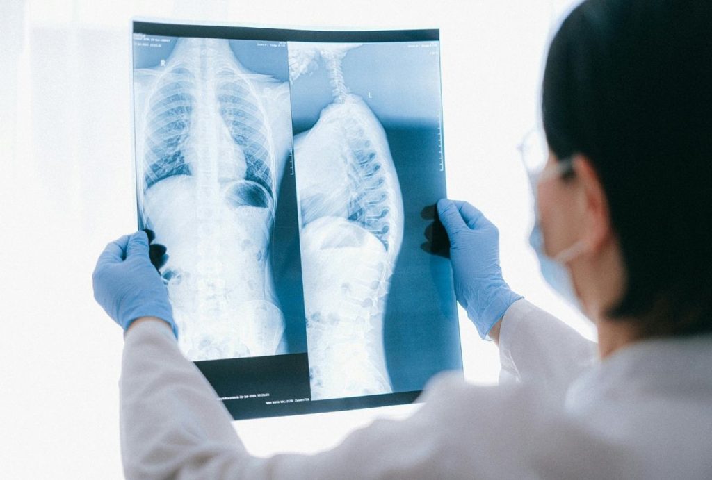 Gloved doctor pointing to spine and chest X-rays for analysis, accessible through convenient walk in X Ray Houston clinics ensuring immediate medical insights.